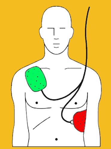 AED elektroden aangesloten op het lichaam