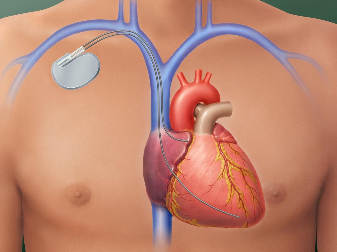 Minder vaak ICD nodig voor patiënt met hartziekte | NTvG