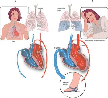 hartfalen: alles wat u wilde weten